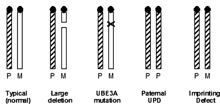 A five-part diagram shows chromosome 15 in its typical (normal) form, with a large deletion, with a UBE3A mutation, with paternal UPD, and with an imprinting defect. The chromosome pairs are depicted as two vertical rectangles arranged in parallel. Some of the rectangles are solid white and some have a black-and-white hatched pattern. The paternal and maternal chromosome in each pair are labeled with a P and an M, respectively.